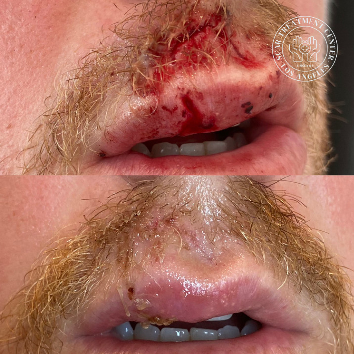 Dog bite nose and upper lip before and after repair at Kare Plastic Surgery Santa Monica Los Angeles by Dr. Raffy Karamanoukian — complex multilayer dog bite wound reconstruction showing closed repair