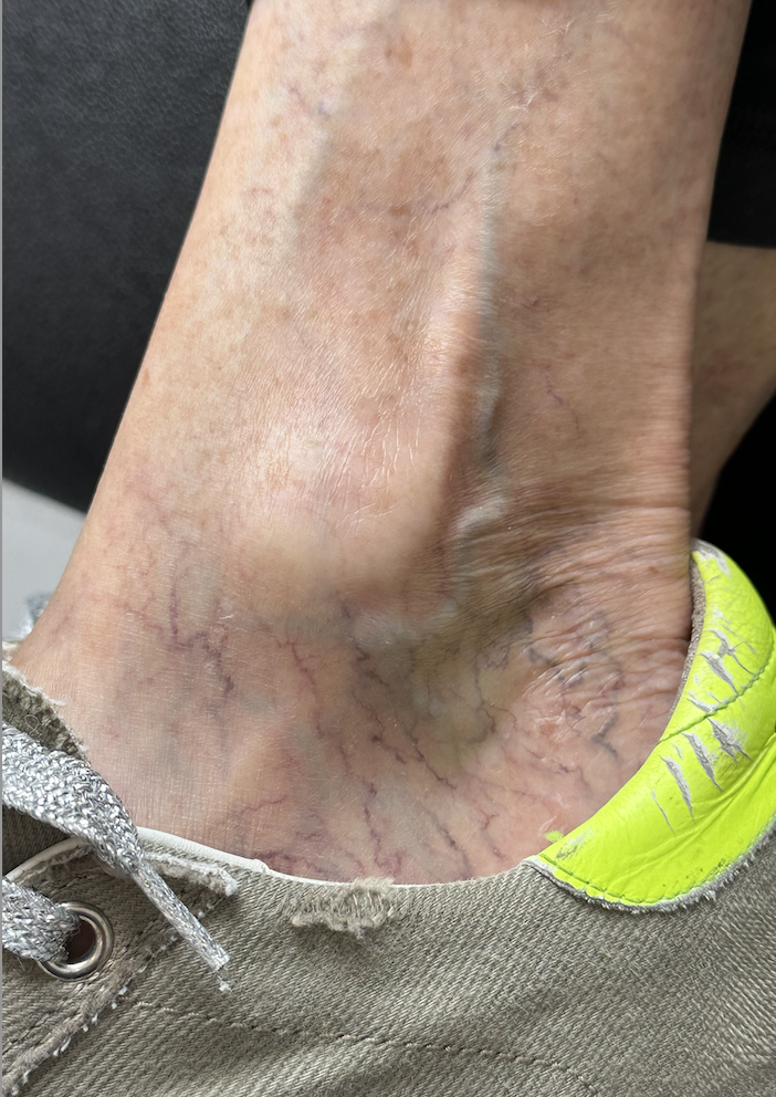 Spider veins and reticular veins of the ankle and foot treated at the Santa Monica Vein Center by board-certified vein surgeon Dr. Raffy Karamanoukian at Kare Plastic Surgery showing extensive spider vein and reticular vein network on the medial ankle and plantar foot in a patient presenting for sclerotherapy consultation