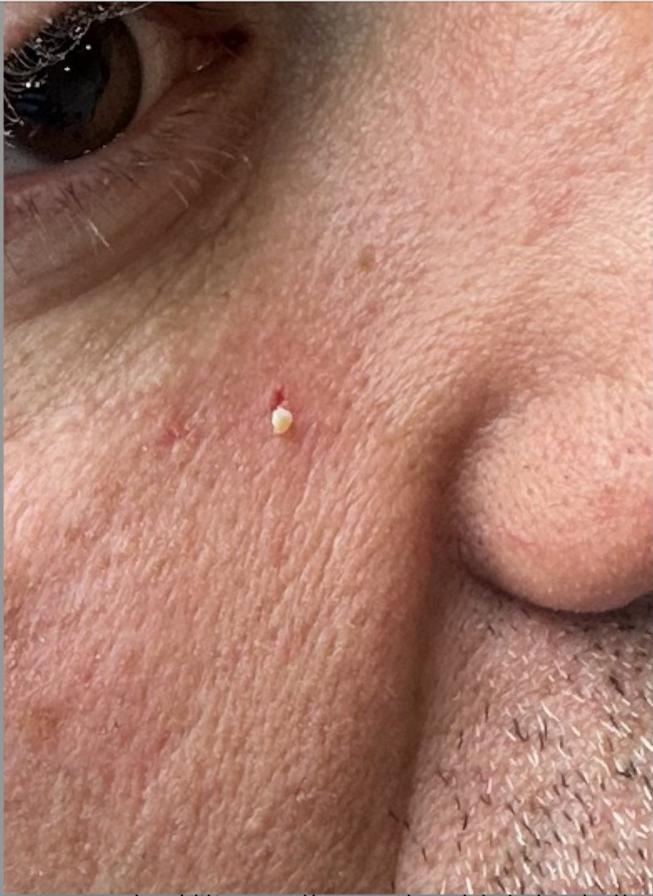 Milia extraction in progress at Kare Plastic Surgery Santa Monica — pearl-white keratin plug being expressed through lancet puncture opening by Dr. Tiffany Sierro