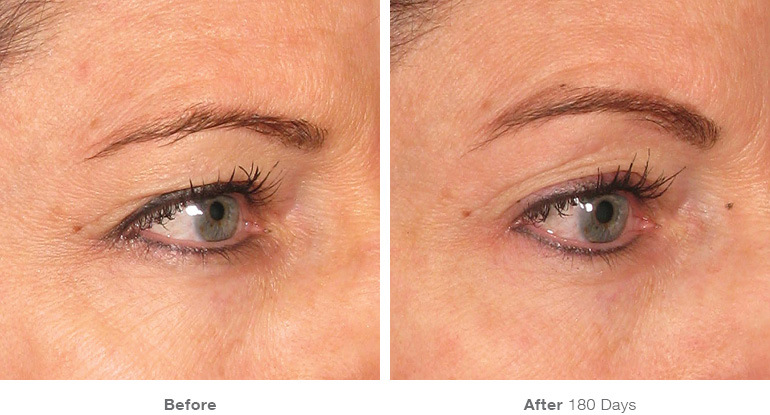 Karesculpt Ultherapy Eyebrow Lift in Santa Monica on Montana Avenue