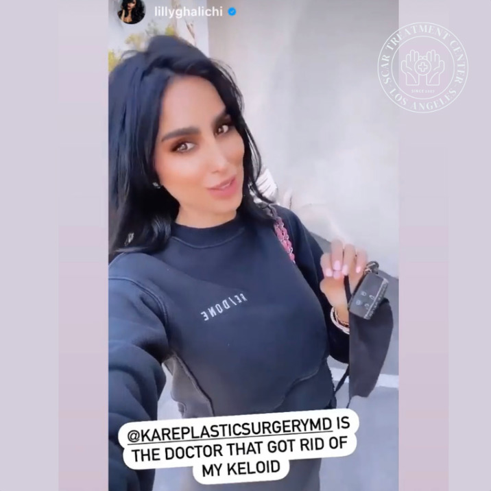 Patient review of Kare Plastic Surgery and Dr. Raffy Karamanoukian for keloid and scar removal in Santa Monica Los Angeles, social media testimonial