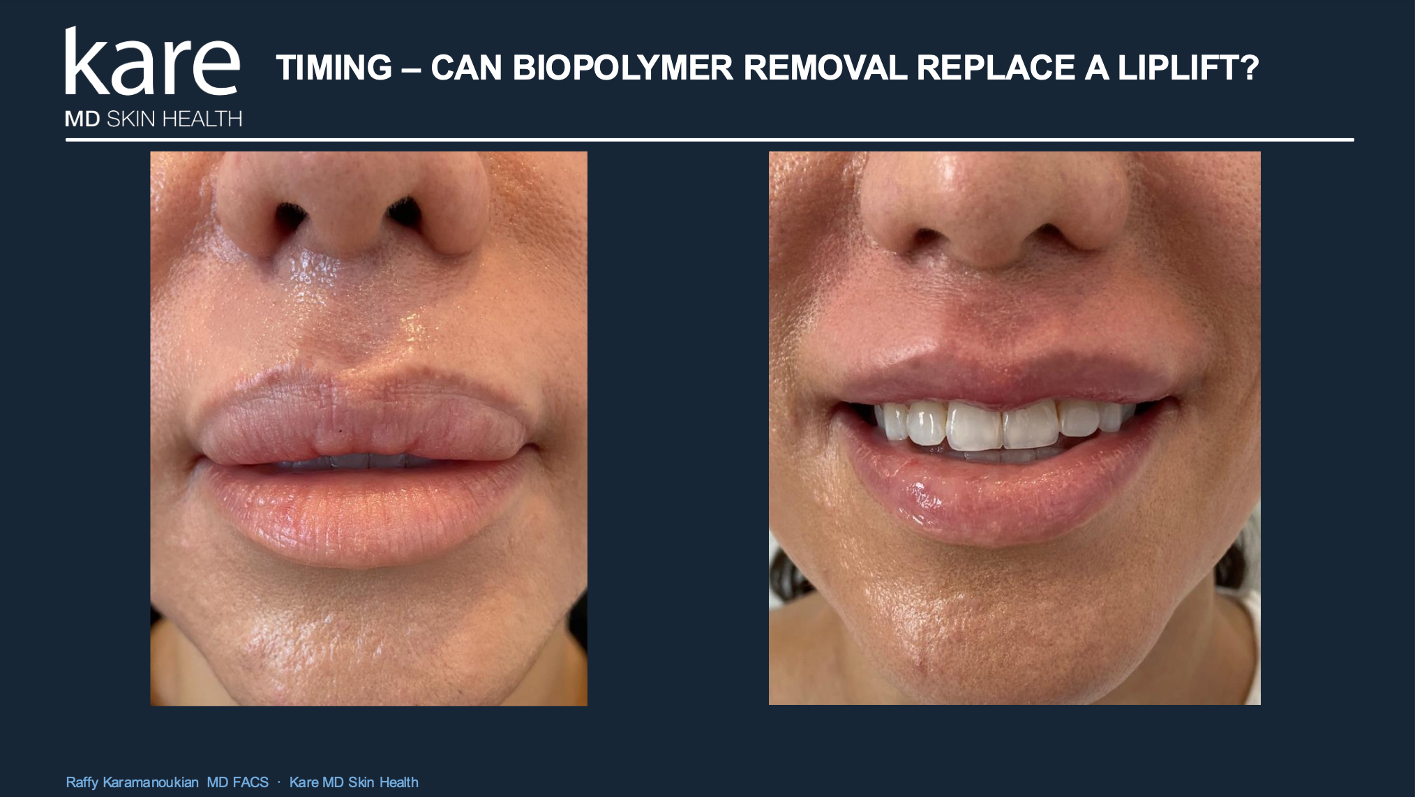 Before and after biopolymer removal and lip reduction at Kare Plastic Surgery Los Angeles by Dr. Raffy Karamanoukian board-certified plastic surgeon showing distorted overfilled lips with biopolymer before treatment and natural proportionate lip result after biopolymer removal and lip reduction surgery asking the question can biopolymer removal replace a lip lift