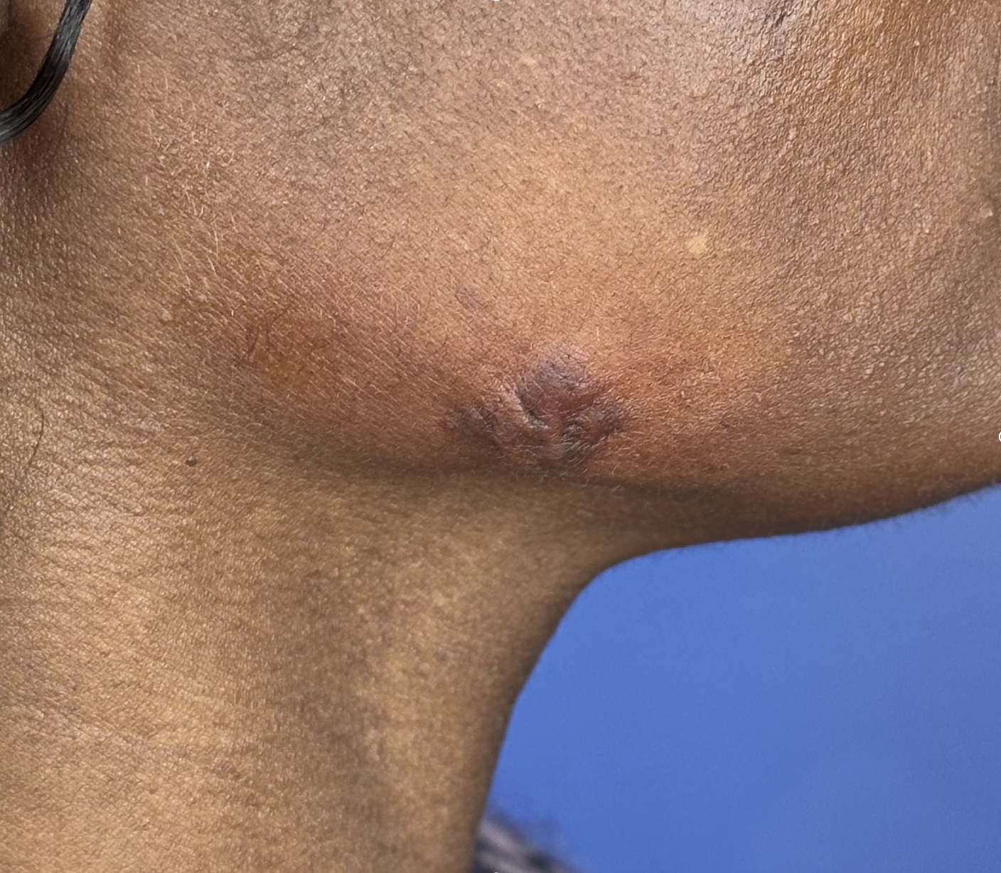 Acne keloid scar at the mandibular angle jawline in a patient with Fitzpatrick type V-VI skin — raised firm hyperpigmented keloid with central erythema and surrounding inflammatory acne involvement treated with non-surgical dermatology protocol by Dr. Tiffany Sierro at Kare Plastic Surgery Santa Monica Los Angeles