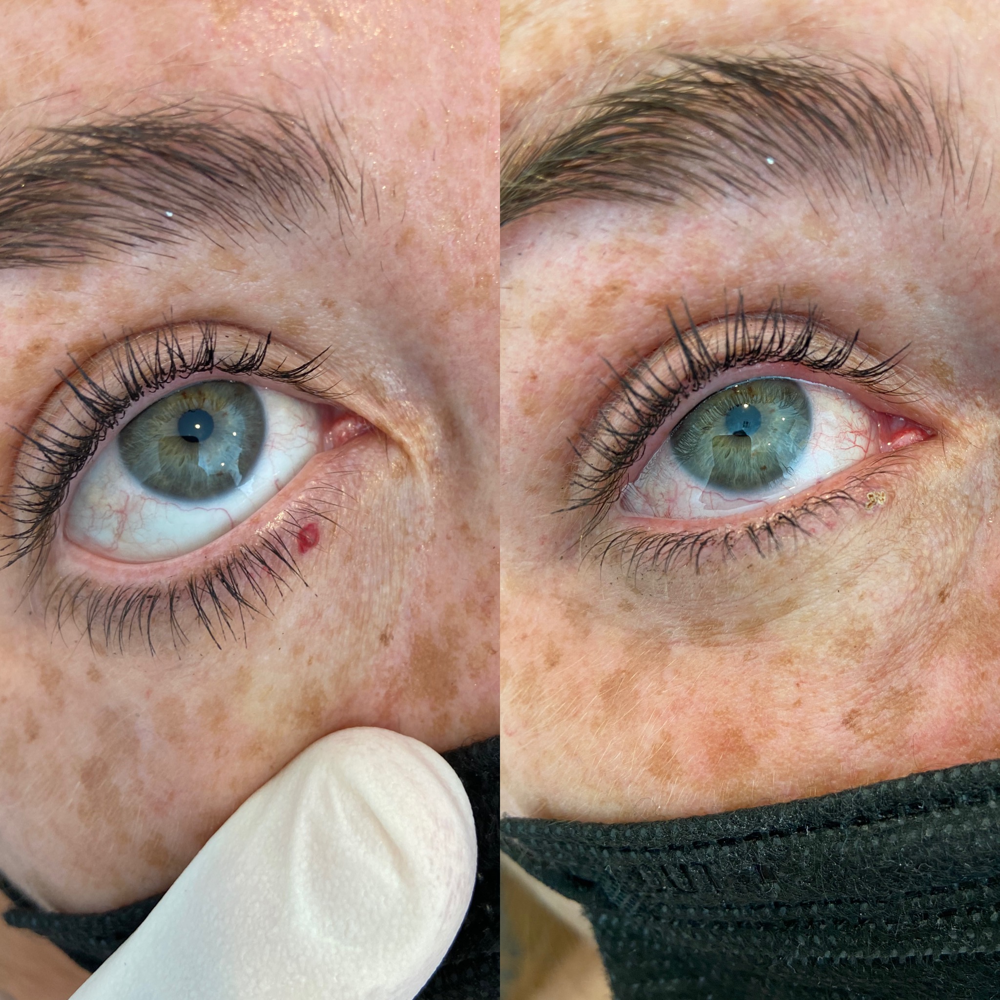 Vbeam cherry angioma removal before and after by Dr. Raffy Karamanoukian at Kare Plastic Surgery Santa Monica Los Angeles — bright red cherry angioma on lower eyelid margin at medial canthus completely eliminated with no scar and natural eyelid anatomy preserved