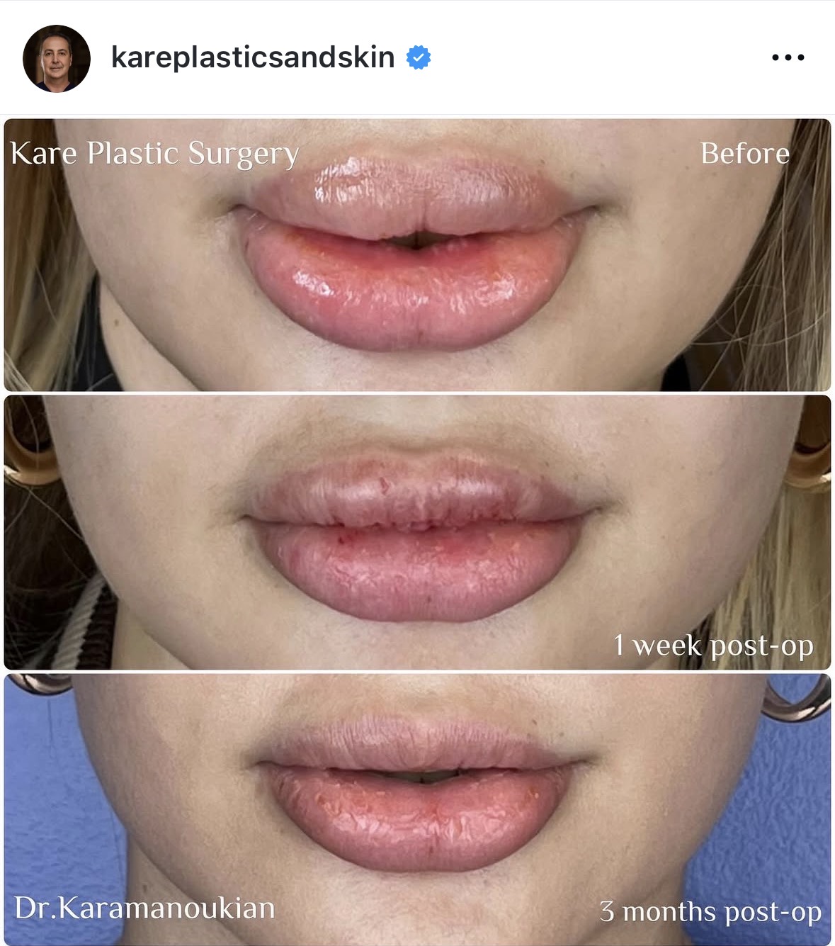Before and after lip filler removal at Kare Plastic Surgery Los Angeles by Dr. Raffy Karamanoukian, showing natural lip contour restored after surgical and enzyme-based removal of excess overfilled lip filler. Individual results vary.