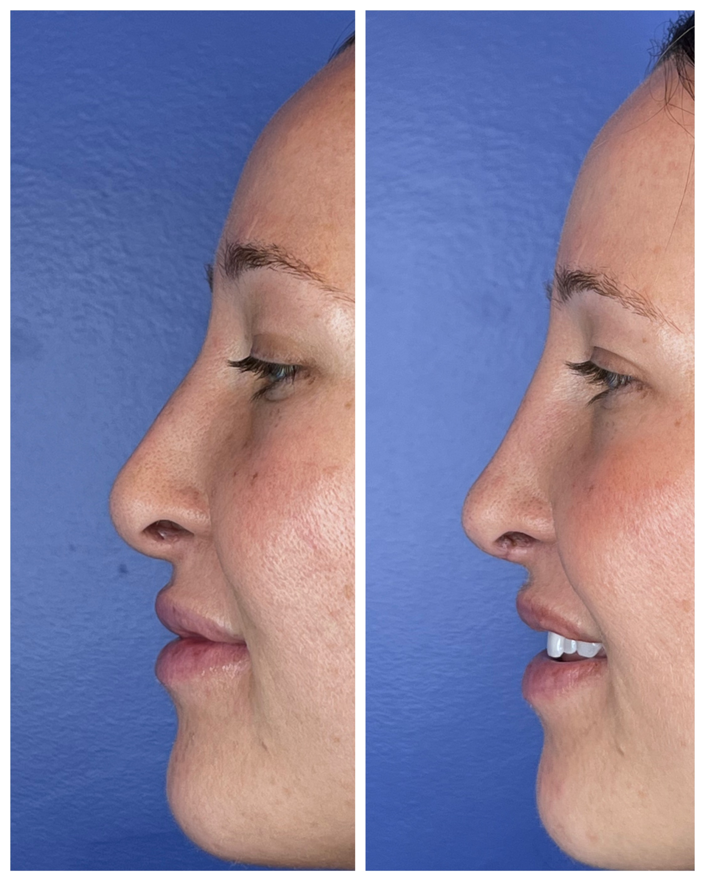 Natural revision rhinoplasty before and after by Dr. Raffy Karamanoukian at Kare Plastic Surgery Santa Monica Los Angeles — dorsal hump reduction, tip refinement, and balanced nasolabial angle producing a natural elegant nasal profile