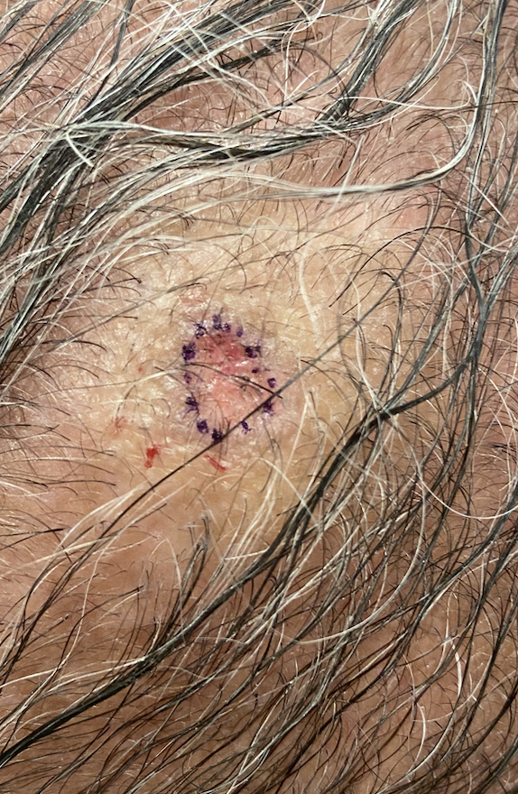 Squamous cell carcinoma of the scalp excised at Kare Plastic Surgery Santa Monica Los Angeles by board-certified dermatologist Dr. Tiffany Sierro showing round excision site with fine suture closure immediately after skin cancer removal from the scalp of an older male patient with background solar photodamage and grey hair