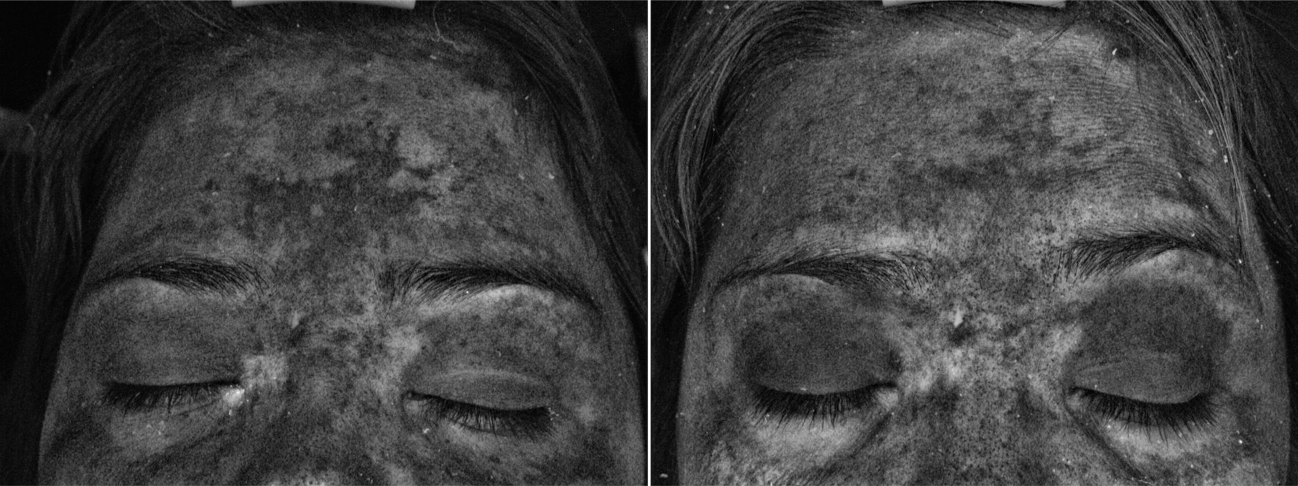 UV Wood's lamp dermatoscopy imaging of severe facial melasma bilateral views at Kare Plastic Surgery Los Angeles by Dr. Karamanoukian showing deep and superficial melanin distribution before skin peel treatment