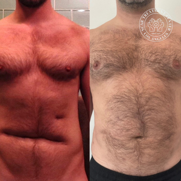 Abdominal body scar before and after treatment at Kare Plastic Surgery Los Angeles Scar Treatment Center by Dr. Karamanoukian — diffuse inflammatory trunk scarring dramatically improved