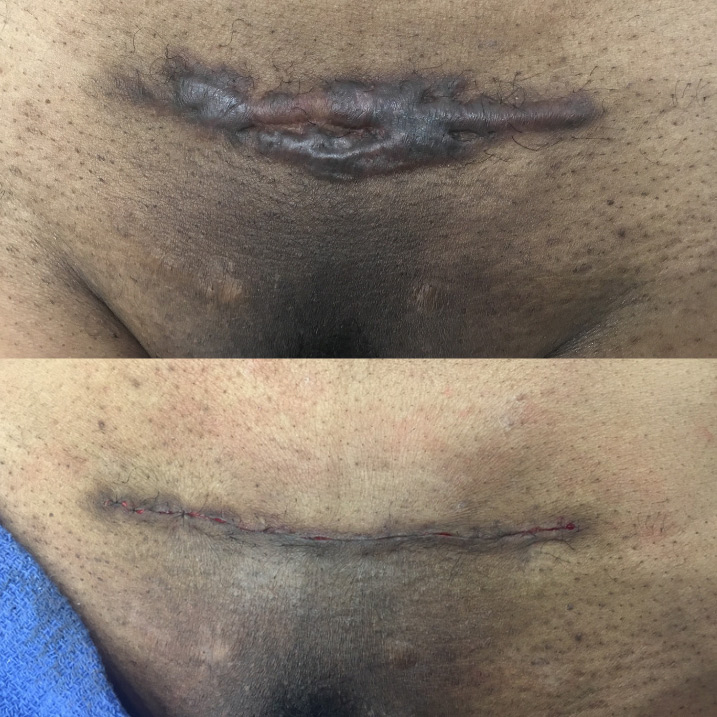 Pubic keloid scar before and after — immediate post-operative result by Dr. Raffy Karamanoukian at Kare Plastic Surgery Santa Monica Los Angeles — large pubic keloid excised with clean linear sutured closure