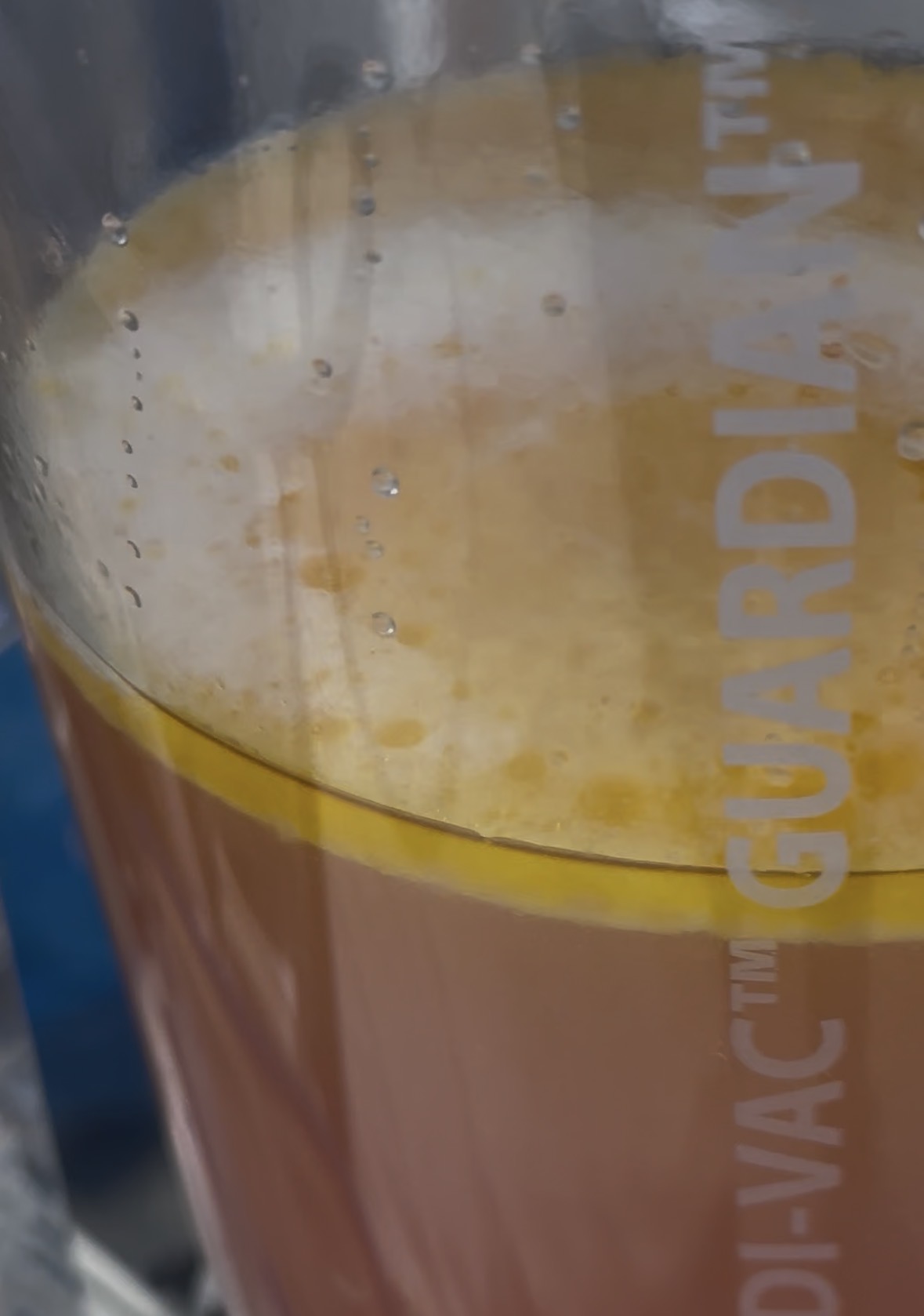 PAH liposuction aspirate in surgical collection canister at Kare Plastic Surgery Santa Monica Los Angeles — showing characteristic dense orange-gold fibrous fat emulsion of paradoxical adipose hyperplasia layered over infusion fluid demonstrating the abnormal density and fibrous character of PAH adipose tissue