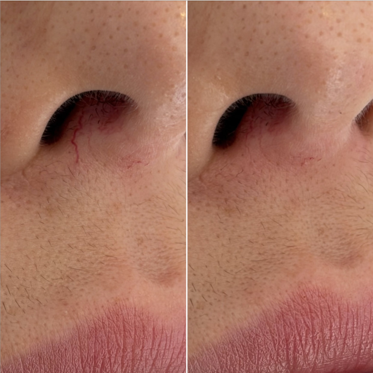 Before and after facial spider vein removal at Kare Plastic Surgery Los Angeles by Dr. Raffy Karamanoukian, showing visible red telangiectasia vessels on the alar of the nose before treatment and significant clearance of the facial spider veins after Vbeam laser treatment. Individual results vary.