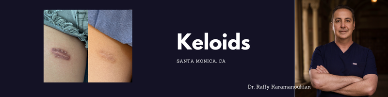 reducing facial scars and keloids in los angeles