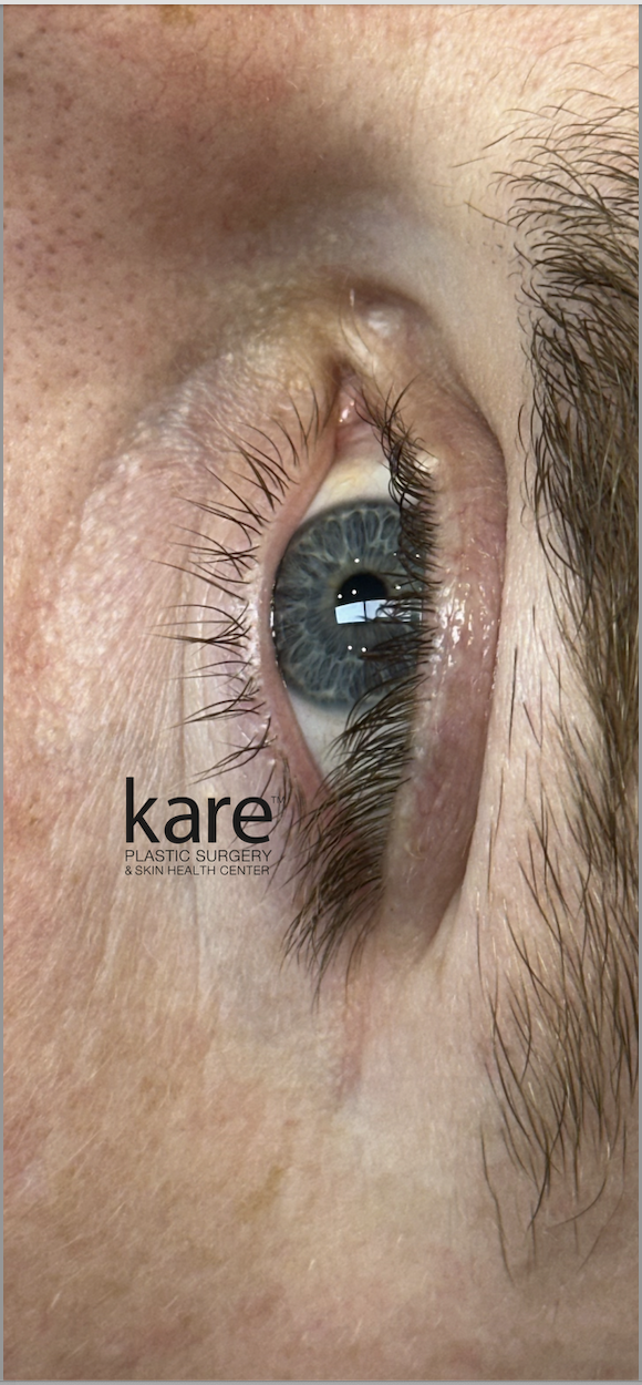 Eyelid milia before treatment at Kare Plastic Surgery Los Angeles showing small firm white keratin cysts along the upper eyelid margin and periorbital skin of a patient treated by Dr. Raffy Karamanoukian