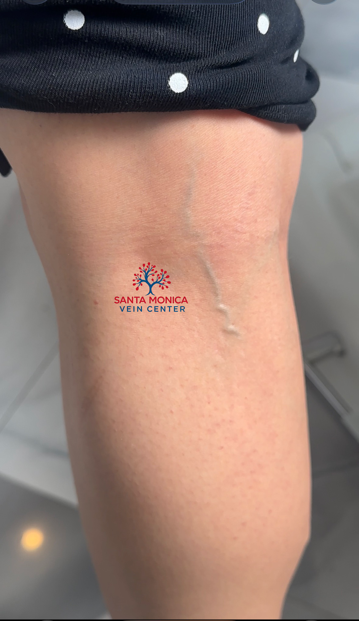 Small varicose vein behind the knee being evaluated and treated at Santa Monica Vein Center by Dr. Raffy Karamanoukian, dual board-certified plastic and vein surgeon, with sclerotherapy or laser vein treatment in Los Angeles