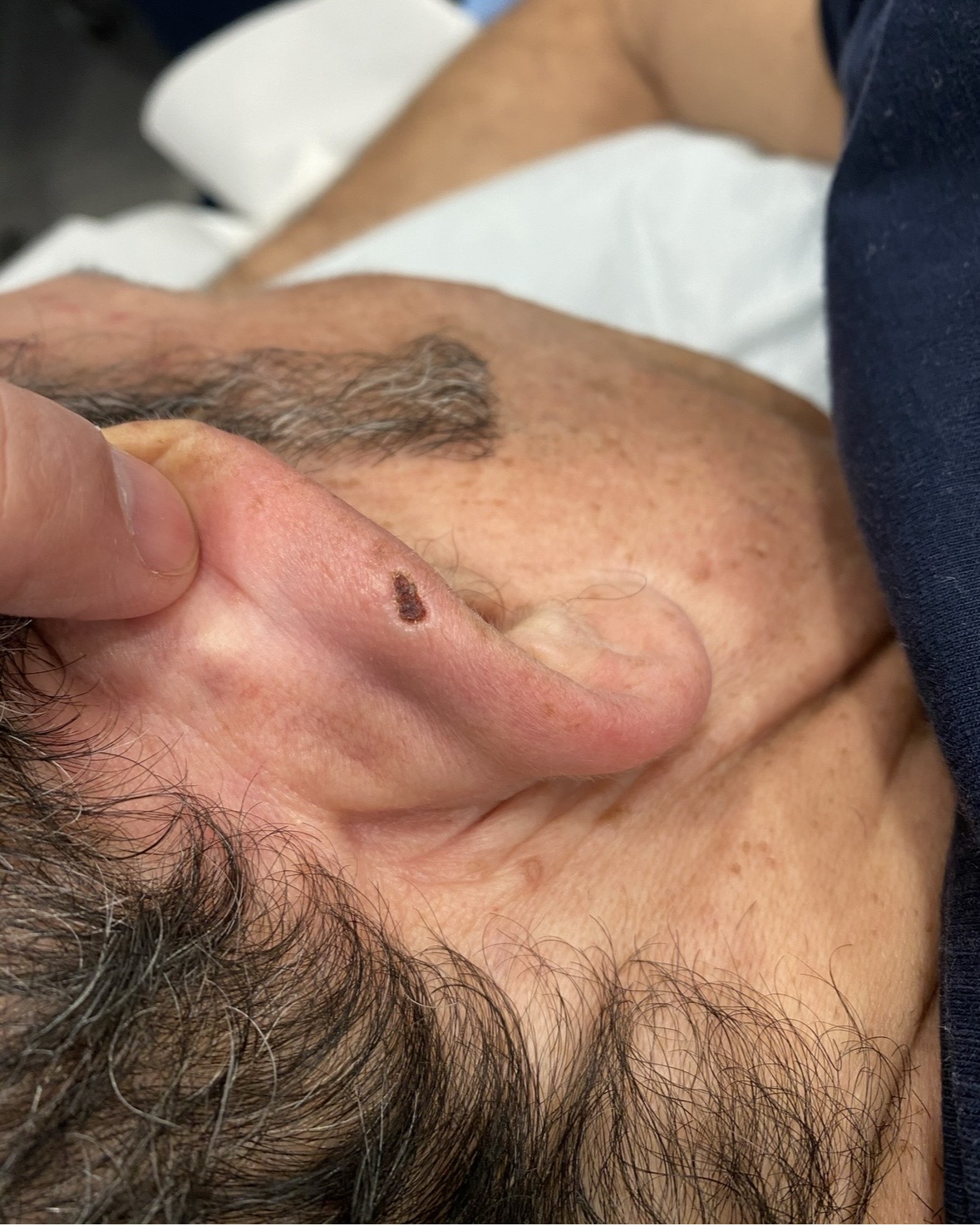 Suspicious darkly pigmented lesion on the auricle of the ear being evaluated for melanoma at the Kare Skin Cancer Center Santa Monica by board-certified dermatologist Dr. Tiffany Sierro showing an irregularly pigmented dark brown and black mole on the helical rim of the ear with concerning features requiring dermoscopy evaluation and same-day biopsy to exclude melanoma or atypical dysplastic nevus