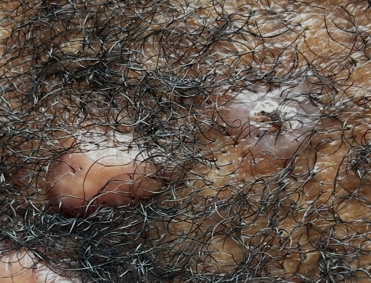Scalp keloid close-up showing raised fibrous keloid scar tissue amid scalp hair, type of keloid scar treated by Dr. Raffy Karamanoukian at Kare Plastic Surgery Los Angeles