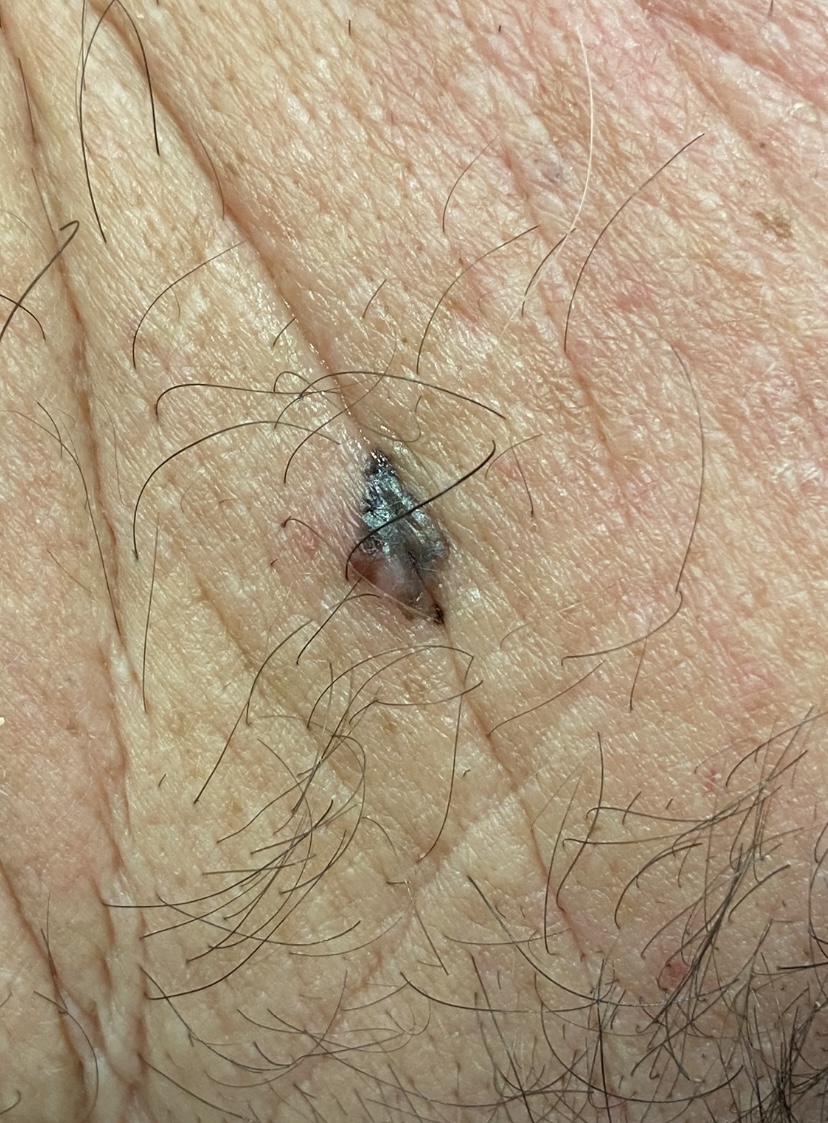 Confirmed melanoma identified at the Santa Monica Skin Cancer Center at Kare Plastic Surgery by board-certified dermatologist Dr. Tiffany Sierro showing pigmented melanocytic lesion with dermoscopic features of melanoma including irregular borders color variation and atypical pigment network on close-up clinical photography of skin surface