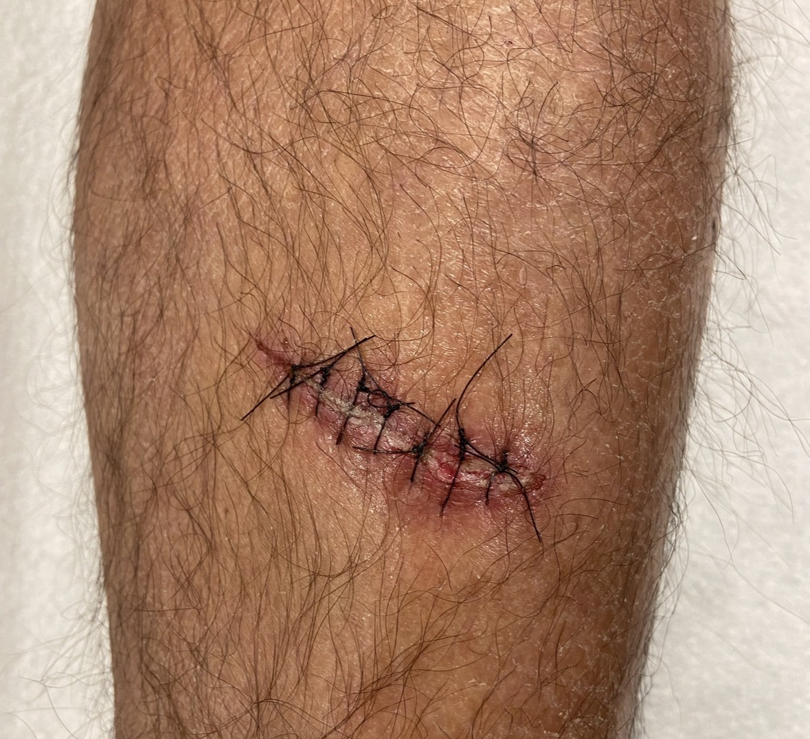 ER stitches requiring removal at Kare Plastic Surgery Santa Monica Los Angeles — five black non-absorbable interrupted nylon sutures on knee laceration with erythema and early crusting around suture entry points — same-day stitch removal appointment with Dr. Raffy Karamanoukian