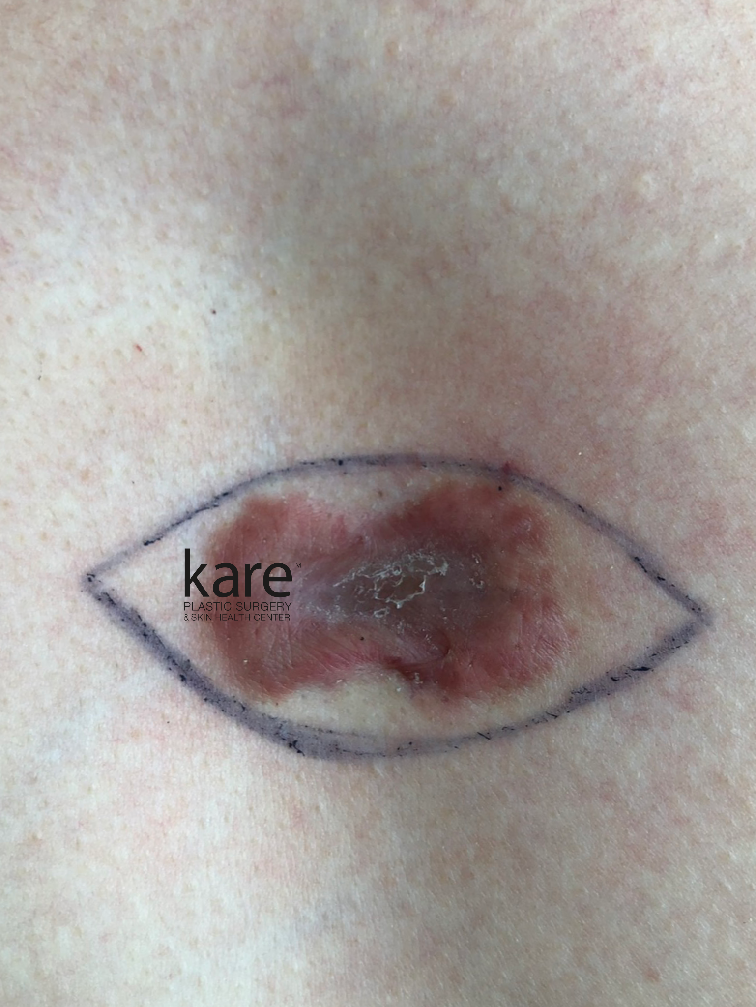 Intraoperative photo showing surgical marking and excision planning for keloid scar removal at Kare Plastic Surgery Los Angeles by Dr. Raffy Karamanoukian, with fusiform ellipse marked for keloid excision