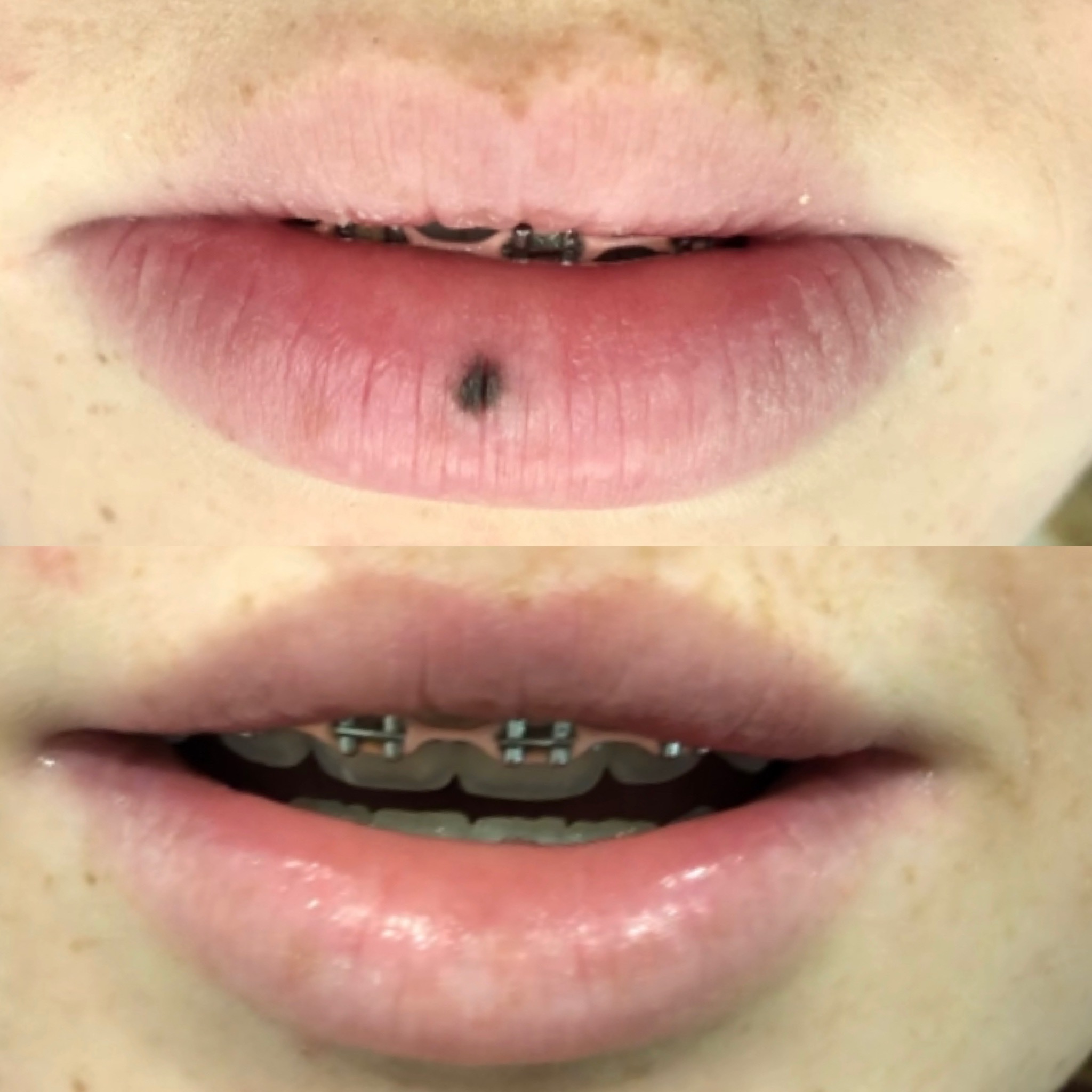 Lip mole removal before and after by Dr. Raffy Karamanoukian at Kare Plastic Surgery Santa Monica Los Angeles — dark pigmented melanocytic lesion on lower lip vermilion removed with no visible scar and natural lip contour fully preserved