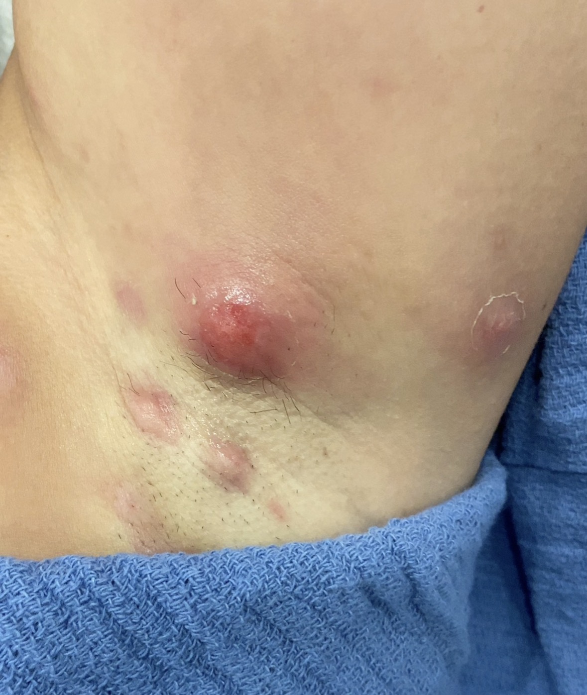 Multiple inflamed epidermal cysts in axillary region treated at Kare Plastic Surgery Santa Monica — pre-operative clinical photograph showing large actively inflamed sebaceous cyst with surrounding post-inflammatory pigmentation and satellite lesion marked for excision by Dr. Raffy Karamanoukian