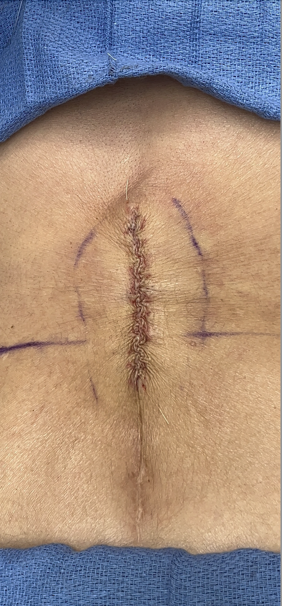 Intraoperative photo showing surgical excision of spinal surgery scar by Dr. Raffy Karamanoukian at Kare Plastic Surgery Los Angeles, with the scar tissue being removed through precise excision technique