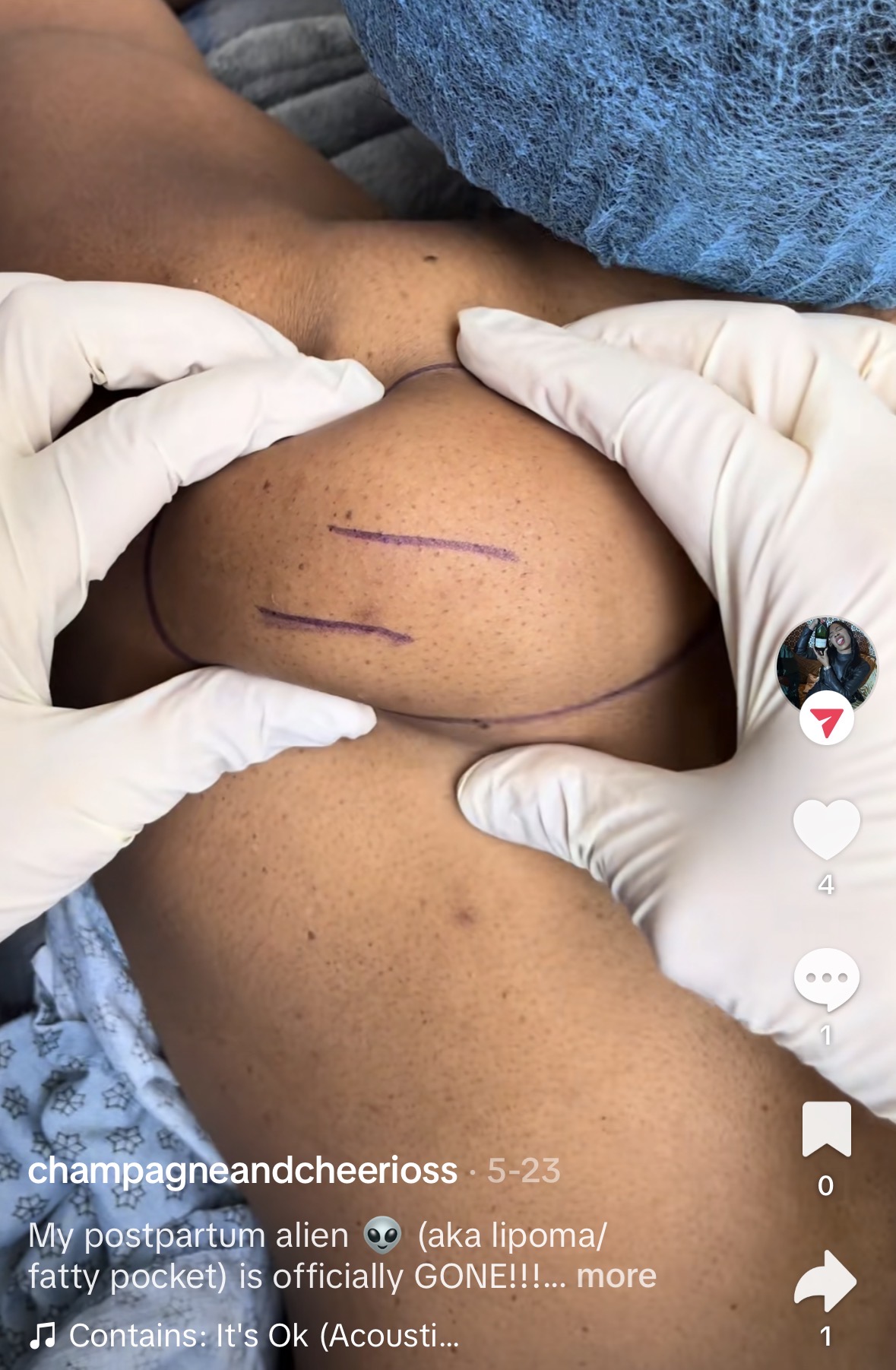 Gloved hands compressing large back lipoma before removal at Kare Plastic Surgery Los Angeles — demonstrating the soft, mobile, well-defined lipoma by Dr. Karamanoukian