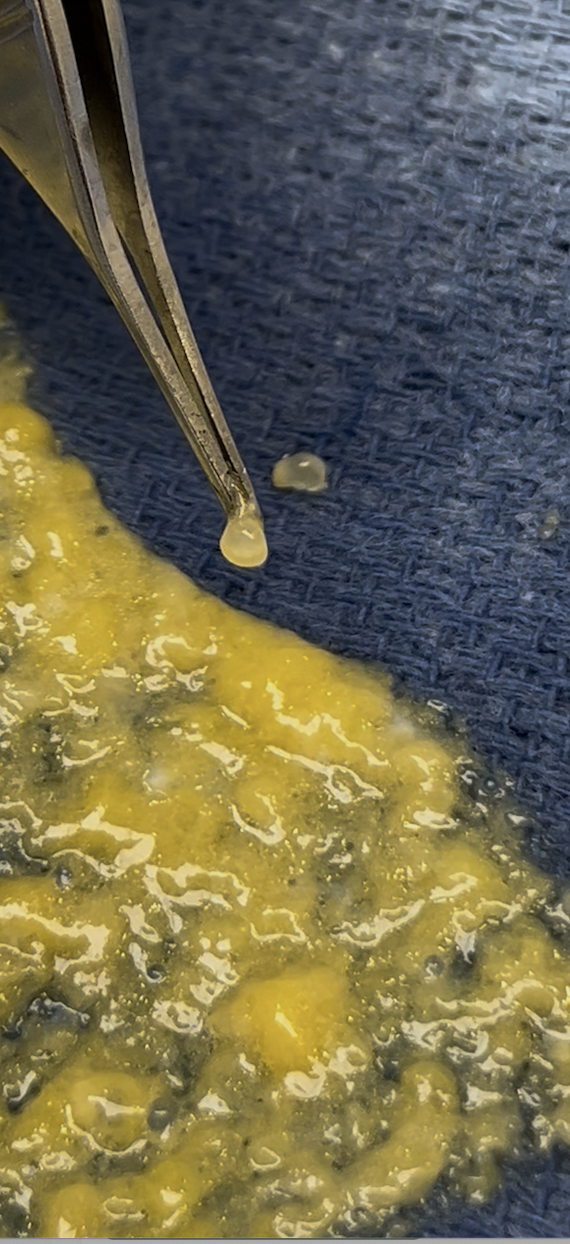 Close-up intraoperative photo showing individual clear silicone particles isolated from granulomatous inflammatory tissue by Dr. Raffy Karamanoukian at Kare Plastic Surgery Los Angeles during silicone biopolymer removal surgery, demonstrating the physical appearance of silicone droplets extracted from tissue