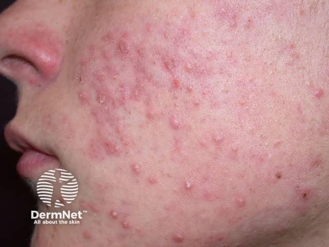 Cystic acne vulgaris showing multiple deep inflammatory papules nodules and cysts on the cheek and jawline the most severe form of acne requiring cortisone injections intralesional steroid treatment and comprehensive dermatologist-managed acne therapy to prevent permanent acne scarring treated by Dr Tiffany Sierro at Kare Plastic Surgery Santa Monica Los Angeles