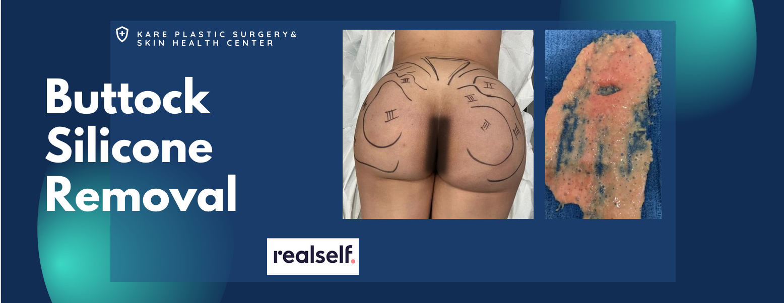 Silicone Removal Los Angeles Removing Bellafill Permanent Filler Removal