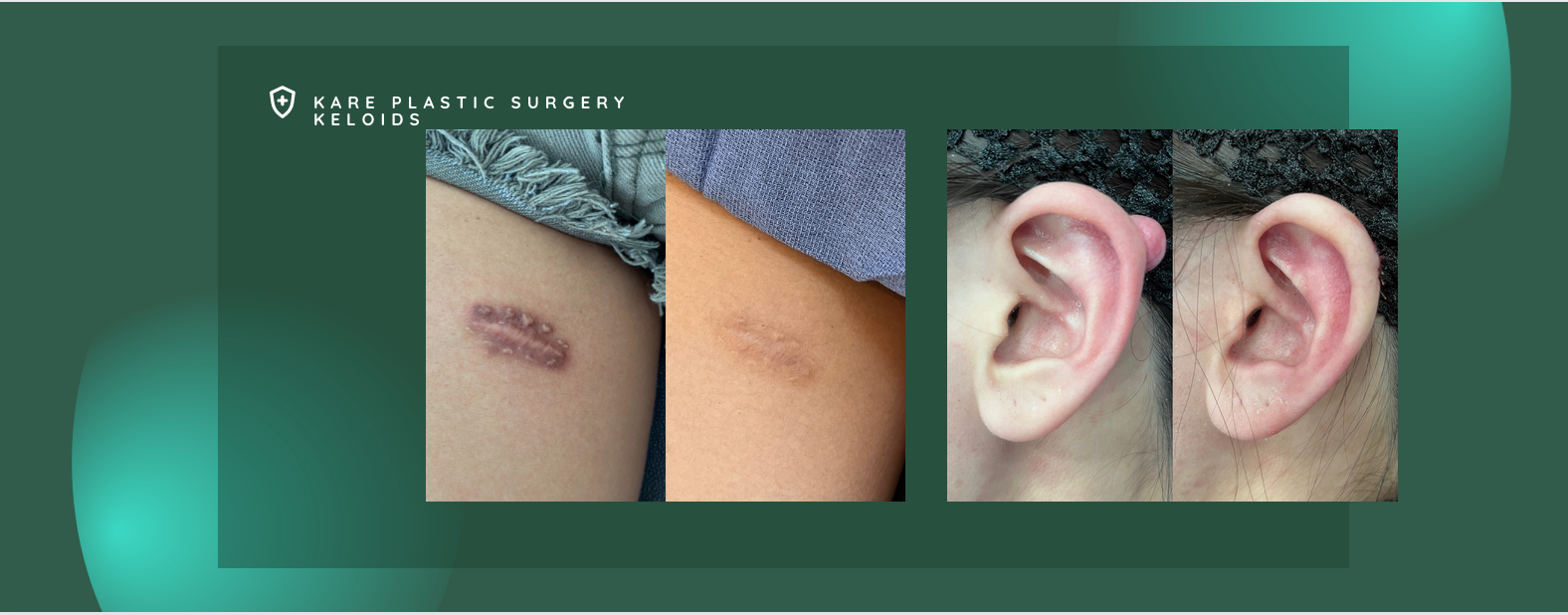 before and after keloid scar removal expert in los angeles