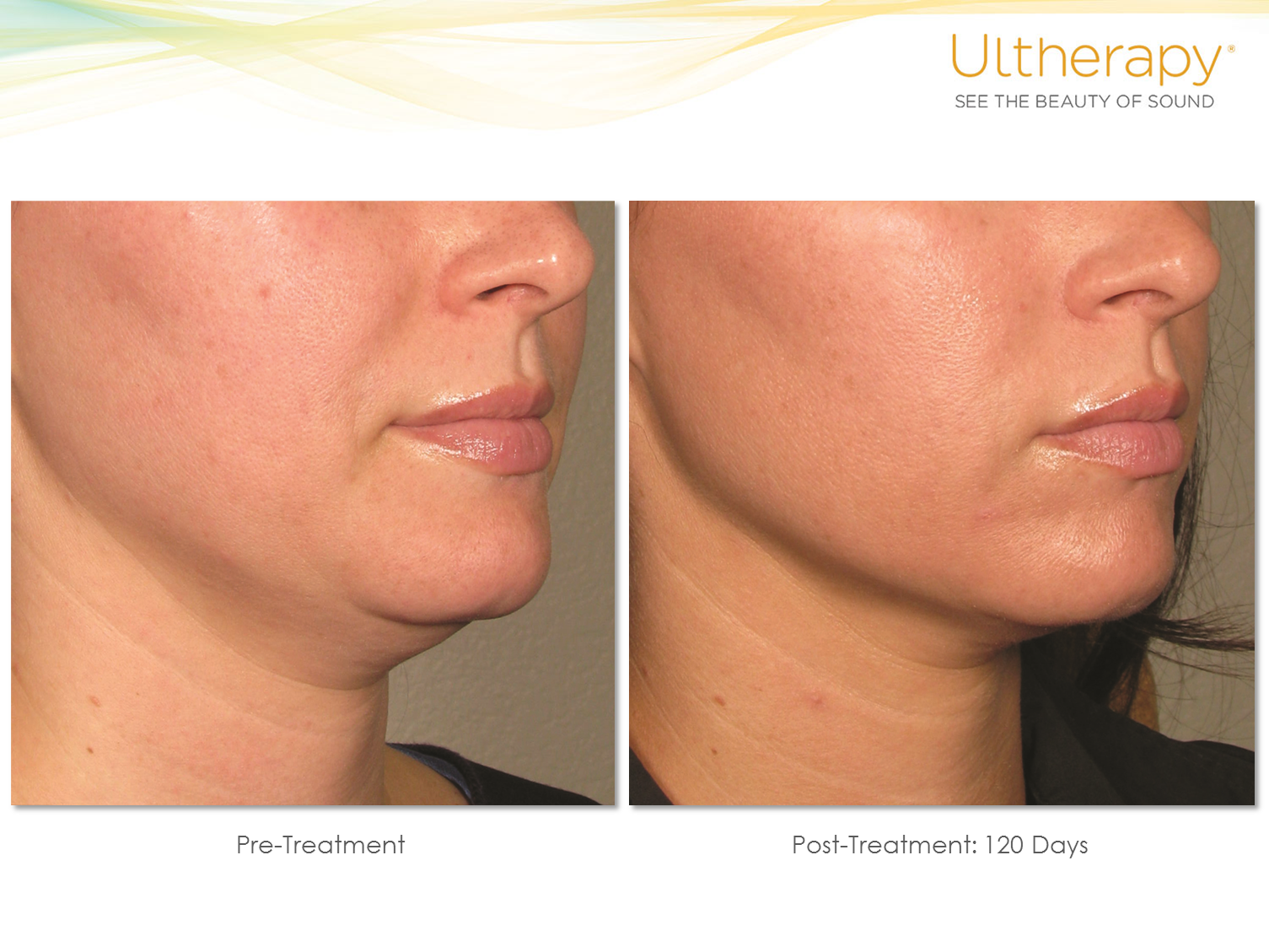 Ultherapy neck lift before and after at 120 days — dramatic submental and jawline tightening showing elimination of double chin, defined jawline, and lifted lower face from Ultherapy non-surgical necklift treatment at Kare Plastic Surgery Santa Monica with Dr. Tiffany Sierro