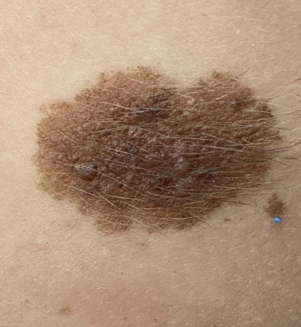 Mole check at Kare Plastic Surgery Santa Monica by board-certified dermatologist Dr. Tiffany Sierro showing large pigmented compound nevus with irregular surface texture color variation and hair follicles evaluated by dermoscopy for melanoma features during full-body skin cancer screening representing the type of lesion assessed during comprehensive mole check examinations