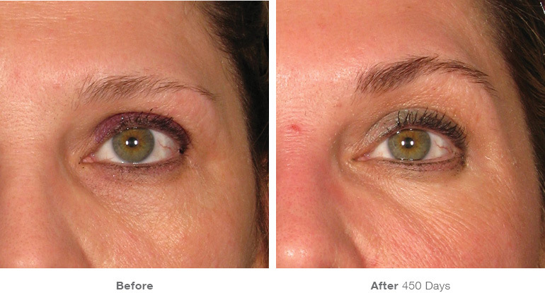 Ultherapy Eyebrow Lift in Santa Monica at Karesculpt