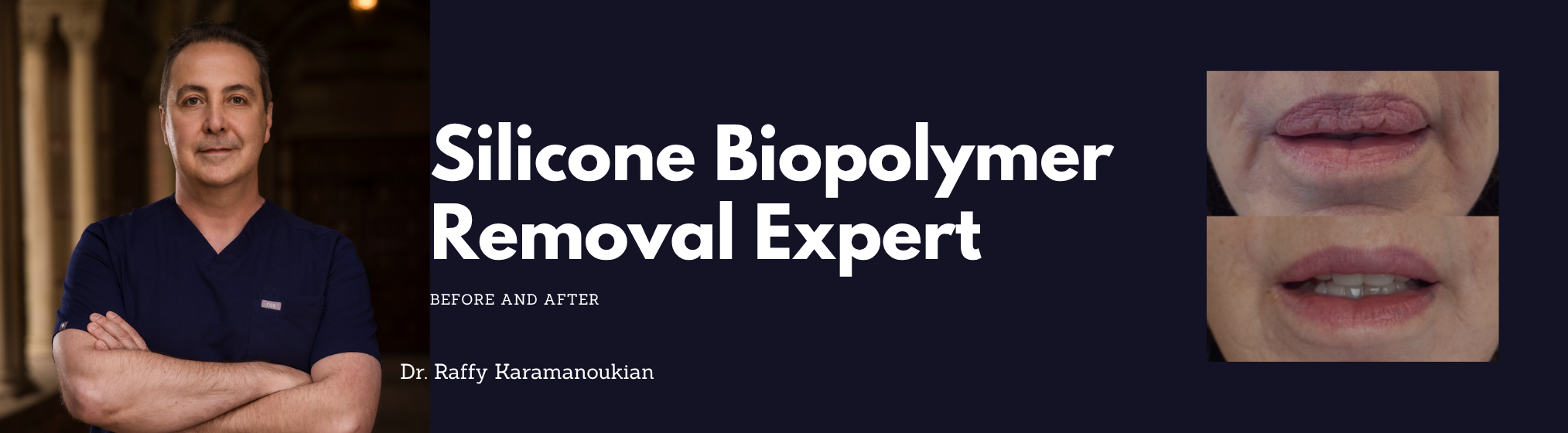 Silicone Biopolymer in the lips with Dr. Raffy Karamanoukian