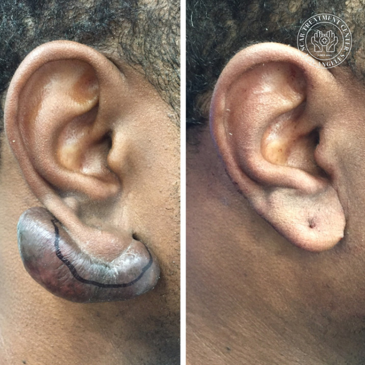 Earlobe keloid before and after treatment at Kare Plastic Surgery Los Angeles