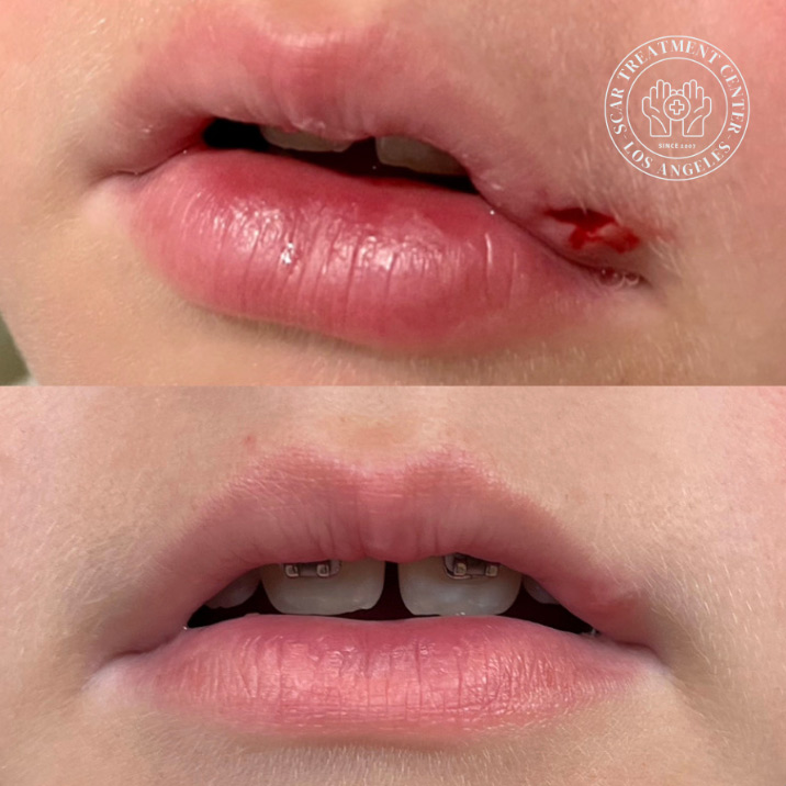 Emergency lip stitches for kids before and after — child lip laceration at the oral commissure and vermilion border repaired by Dr. Raffy Karamanoukian at Kare Plastic Surgery Santa Monica Los Angeles — LA Scar Treatment Center — completely healed with no visible scar