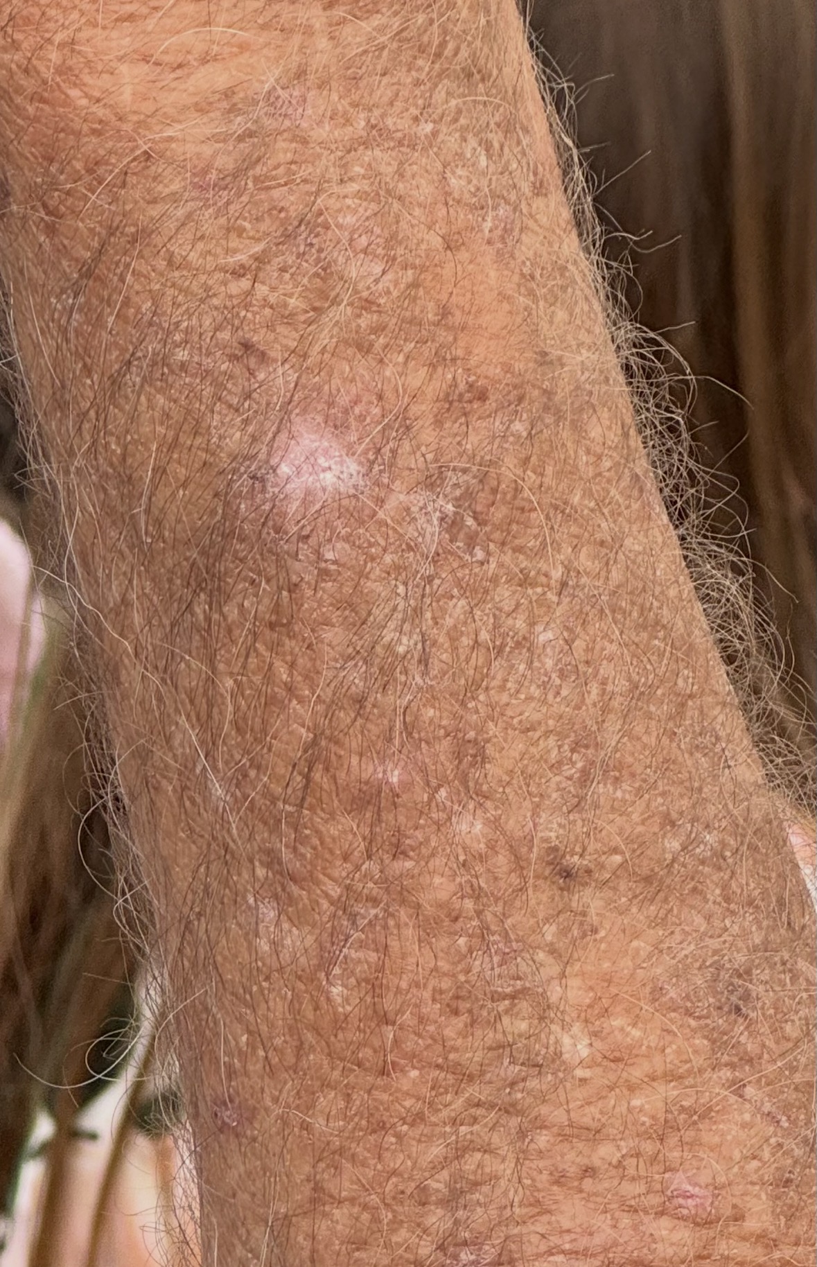 Actinic keratosis field cancerization on forearm and elbow — severe solar photodamage with multiple rough scaly AK lesions, solar lentigines, and hyperkeratotic elbow lesion requiring field treatment at Kare Skin Health Center Santa Monica by Dr. Tiffany Sierro