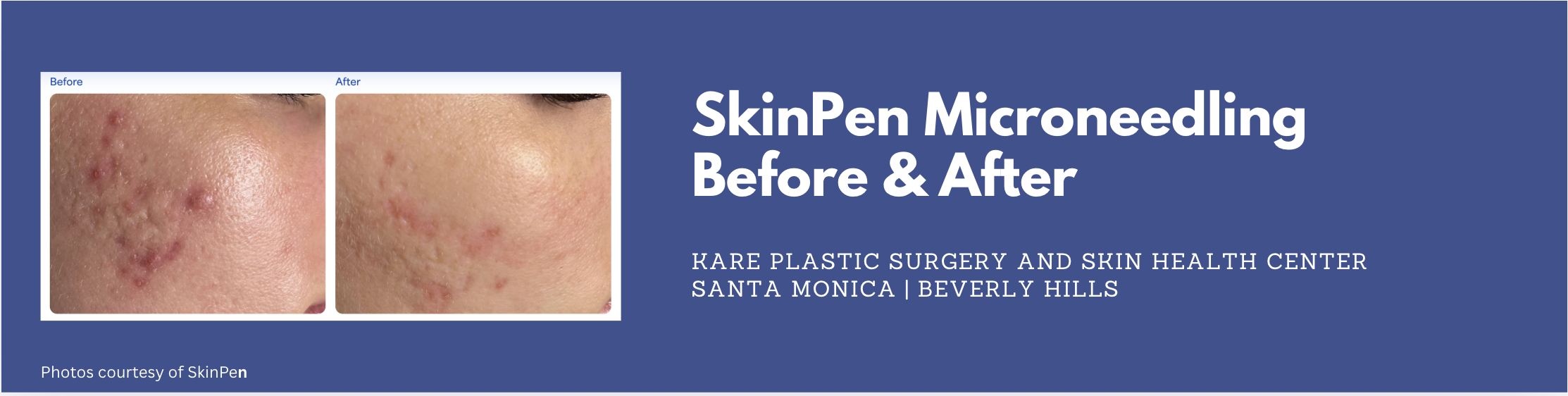 microneedling skinpen in santa monica
