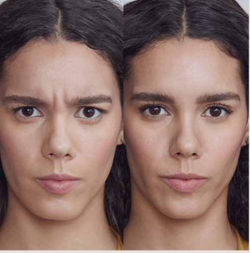 Before and after Botox and Dysport frown line treatment at Kare Plastic Surgery Santa Monica by Dr. Tiffany Sierro board-certified dermatologist showing significant reduction of glabellar frown lines between the eyebrows with natural preserved expression and full facial movement courtesy Allergan