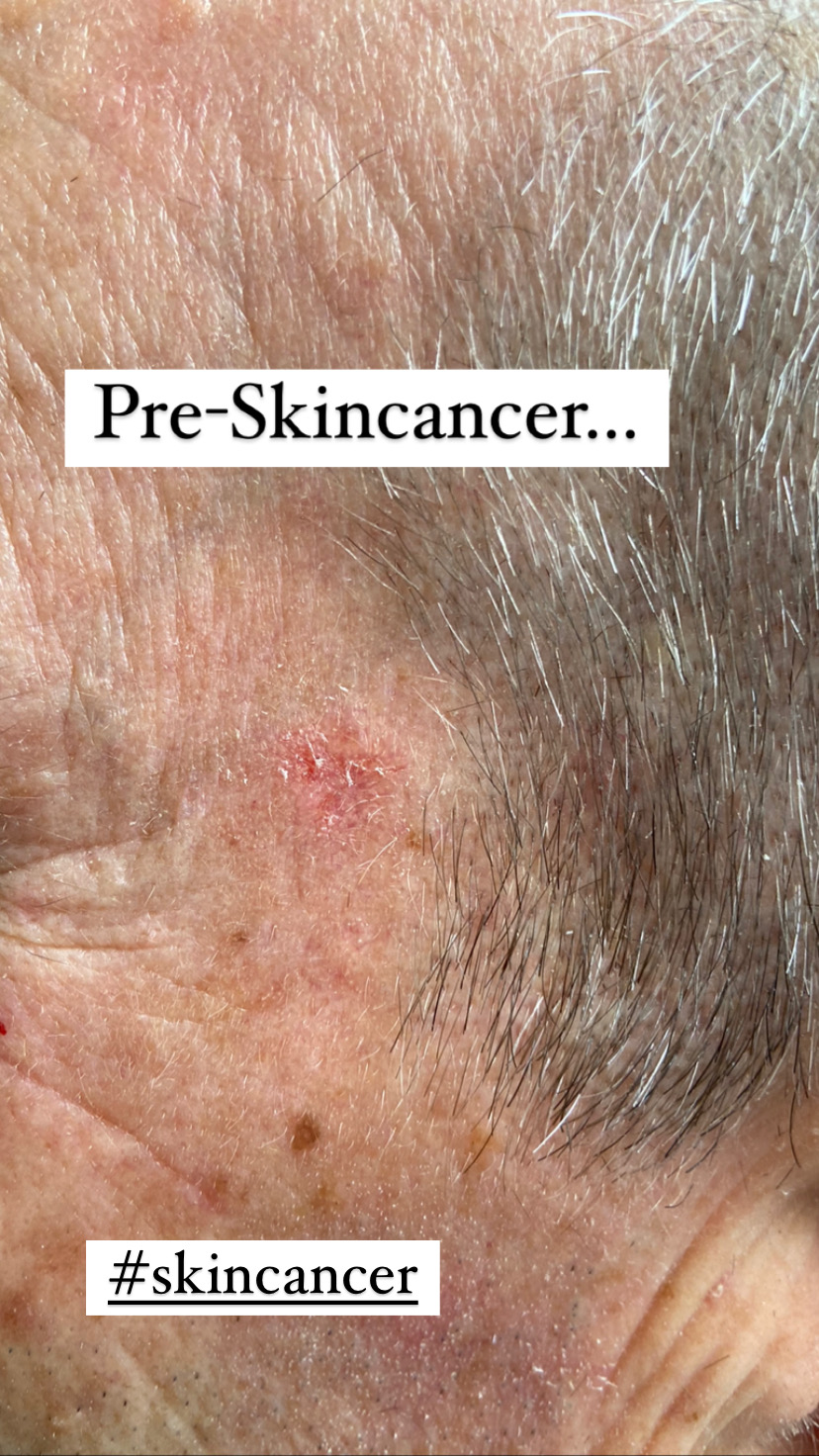 Actinic keratosis pre-skin cancer lesion identified at the Kare Skin Cancer Center Kare Plastic Surgery Los Angeles Santa Monica by board-certified dermatologist Dr. Tiffany Sierro showing rough scaly erythematous pre-cancerous lesion on sun-damaged skin of older patient requiring treatment with cryotherapy or field therapy to prevent progression to squamous cell carcinoma