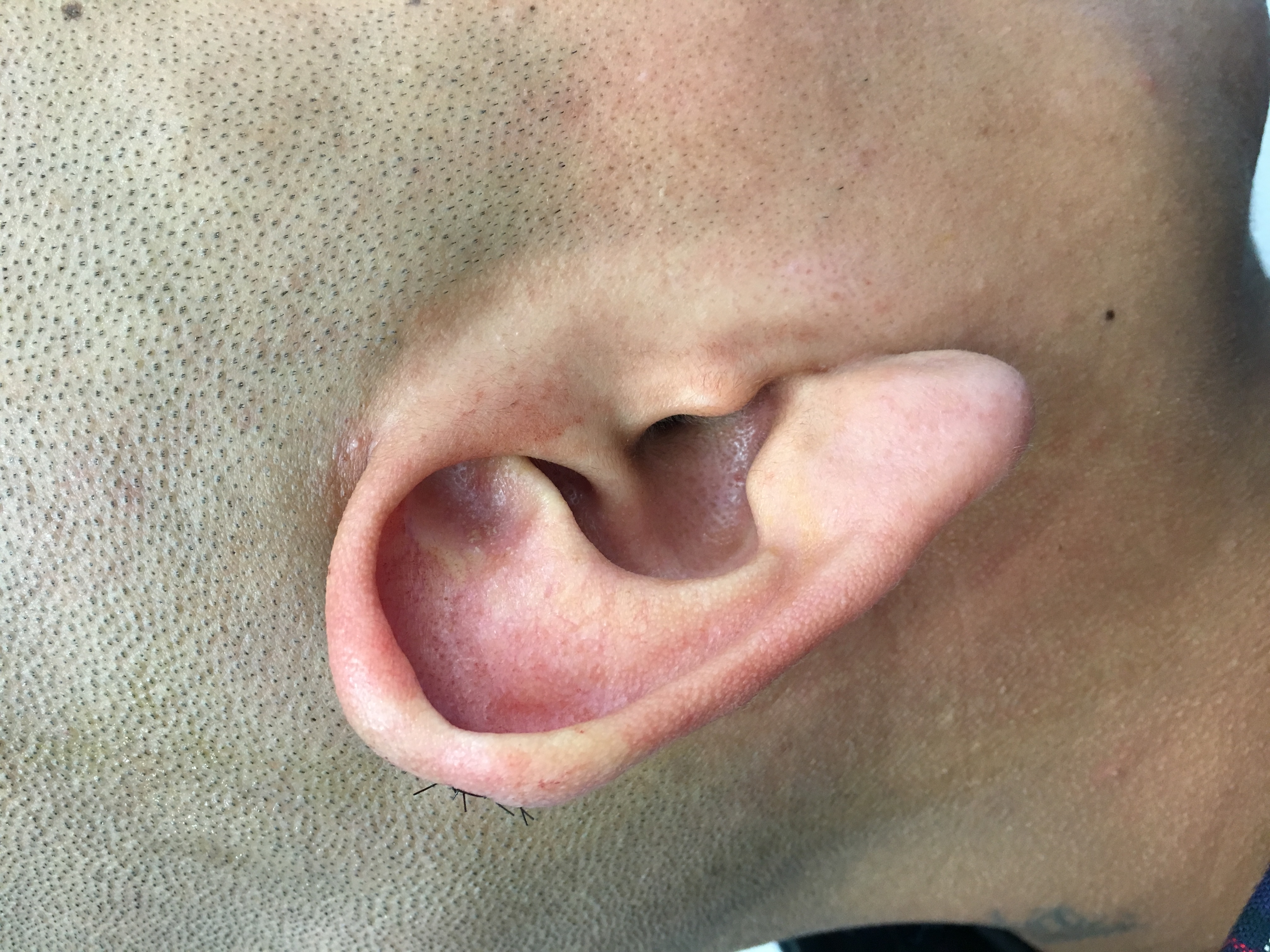 Ear keloid after surgery by Dr. Karamanoukian Los Angeles