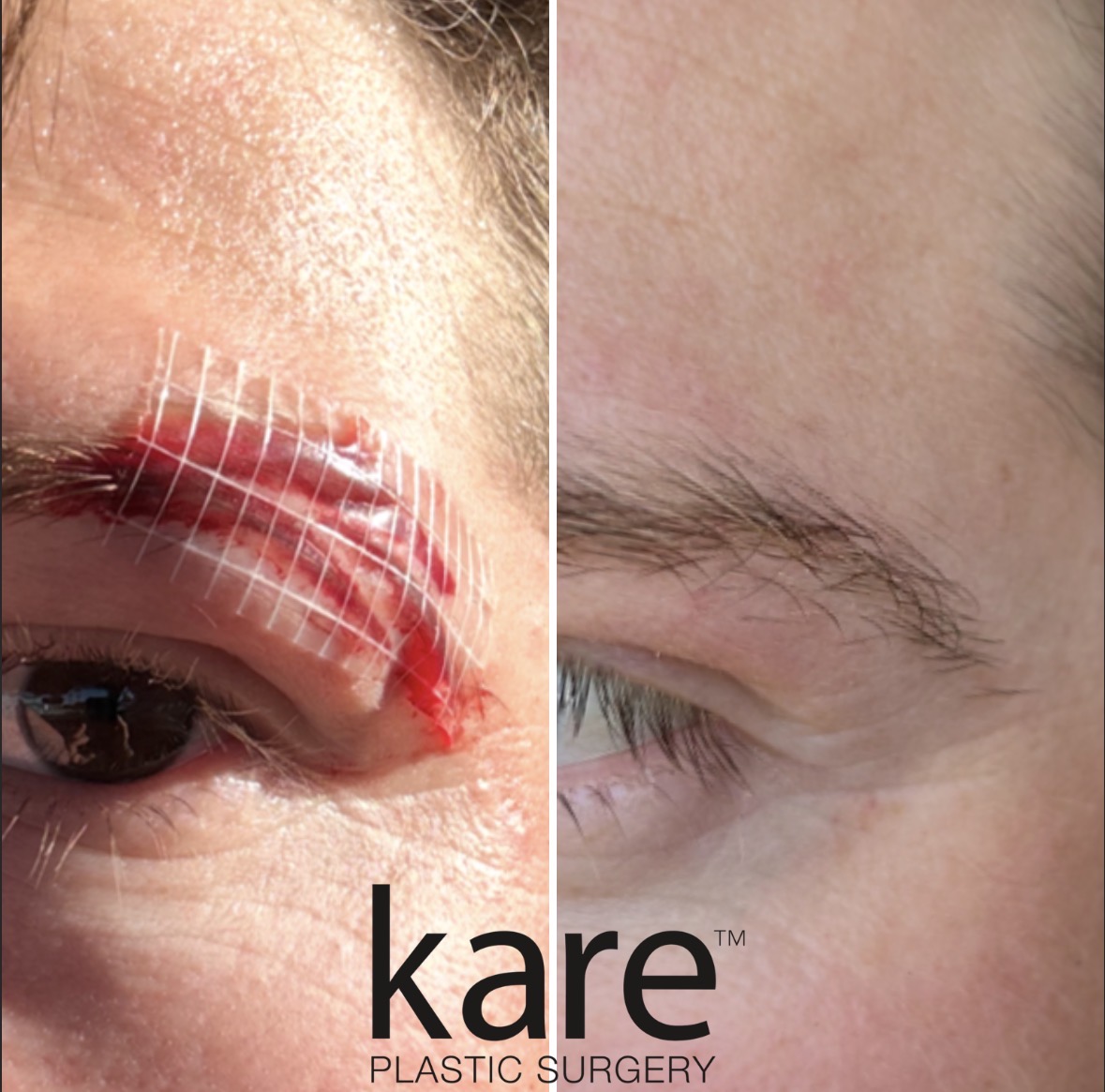 Before and after eyebrow laceration repair by Dr. Raffy Karamanoukian board-certified plastic surgeon at Kare Plastic Surgery Los Angeles showing complex laceration to eyebrow and upper eyelid on left with well-healed minimal scar result on right demonstrating expert cosmetic wound closure and revision stitch technique