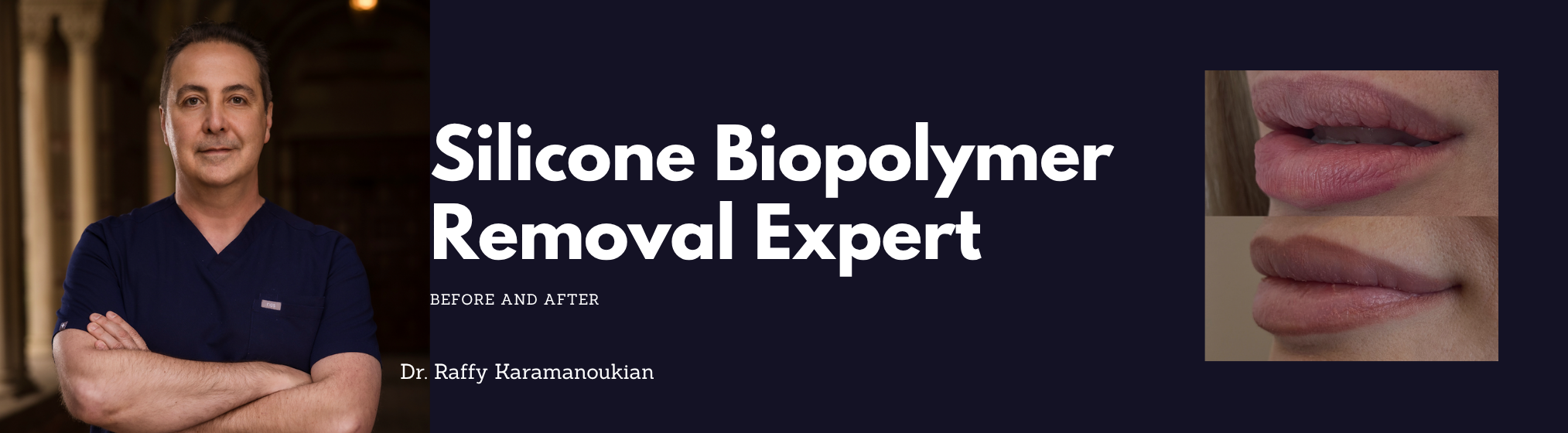 silicone biopolymer removal in los angeles