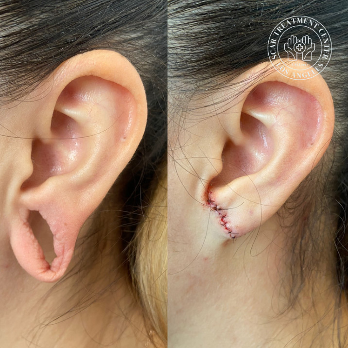 Before and after torn earlobe repair in Los Angeles by Dr. Raffy Karamanoukian board-certified plastic surgeon at Kare Plastic Surgery showing split earlobe with complete tear on left and immediate post-repair result with precise suture closure on right demonstrating expert earlobe repair surgical technique