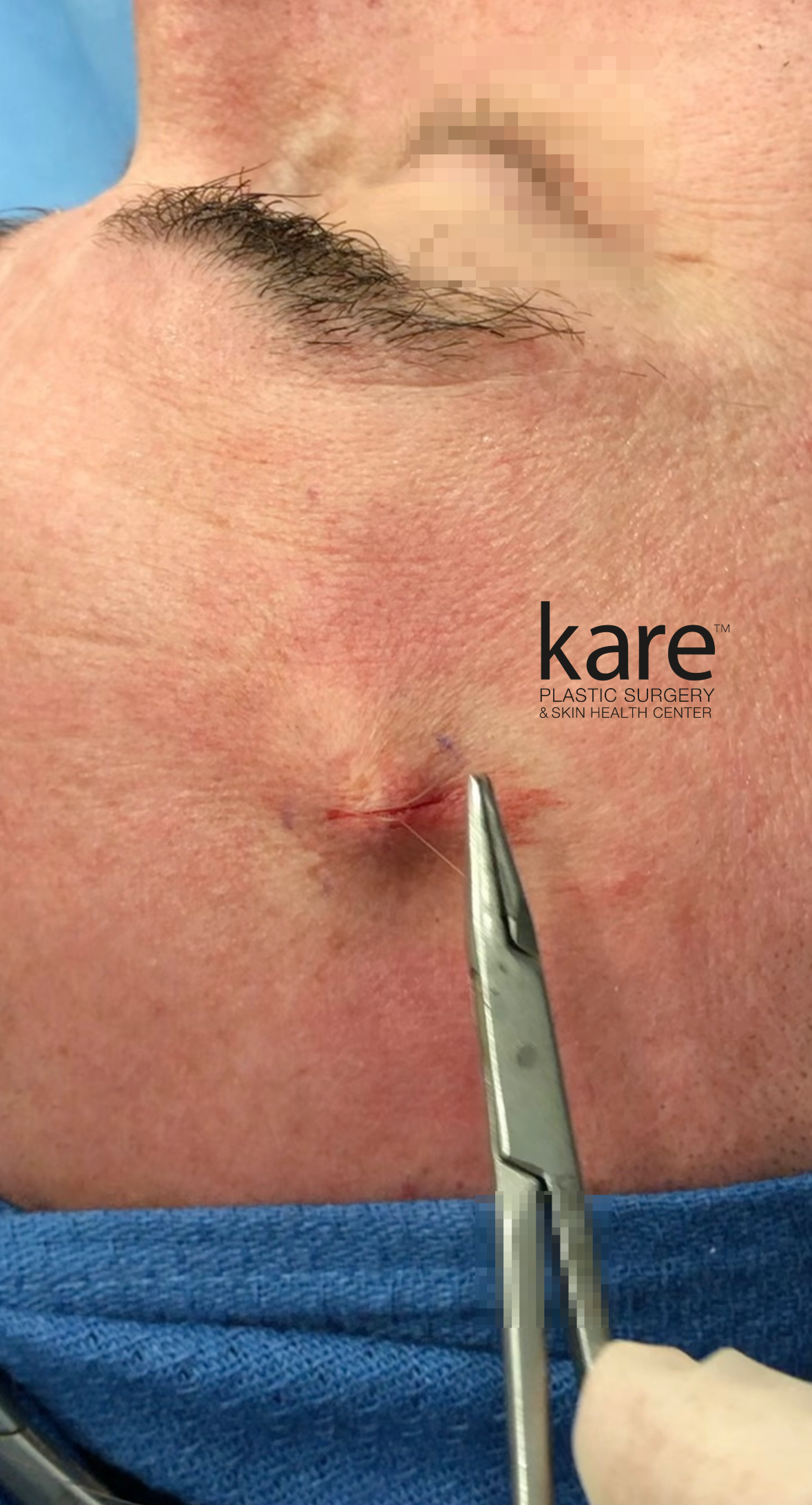 Intraoperative photo showing meticulous wound closure after forehead lipoma removal by Dr. Raffy Karamanoukian at Kare Plastic Surgery Los Angeles, demonstrating the small incision size and precise suture technique.