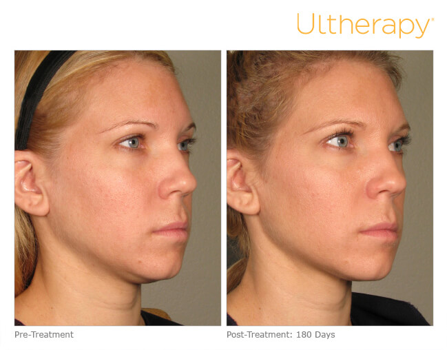 Before and after Ultherapy jawline sculpting and neck tightening treatment showing significant improvement in jawline definition jowl reduction mandibular border clarity and neck skin tightening at 180 days post-treatment performed by Dr. Tiffany Sierro at Kare Plastic Surgery Santa Monica Los Angeles FDA-cleared focused ultrasound non-surgical jawline lifting and contouring