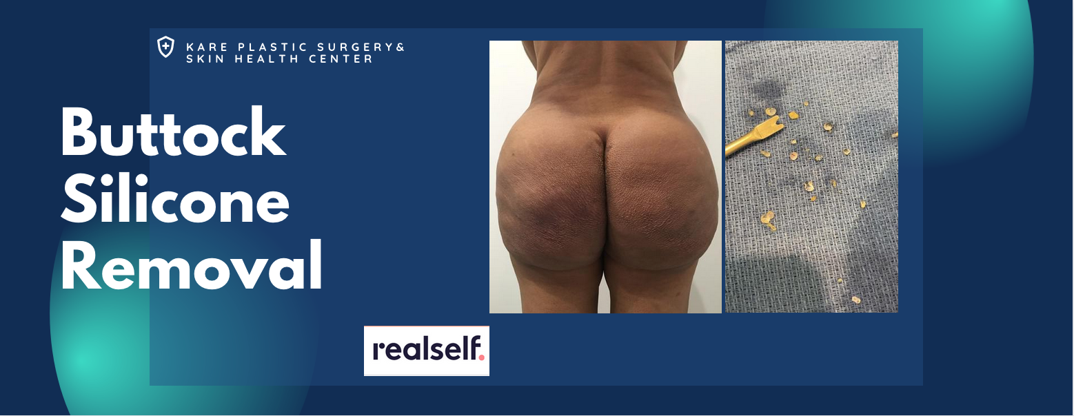 BBL silicone removal from the buttocks in los angeles