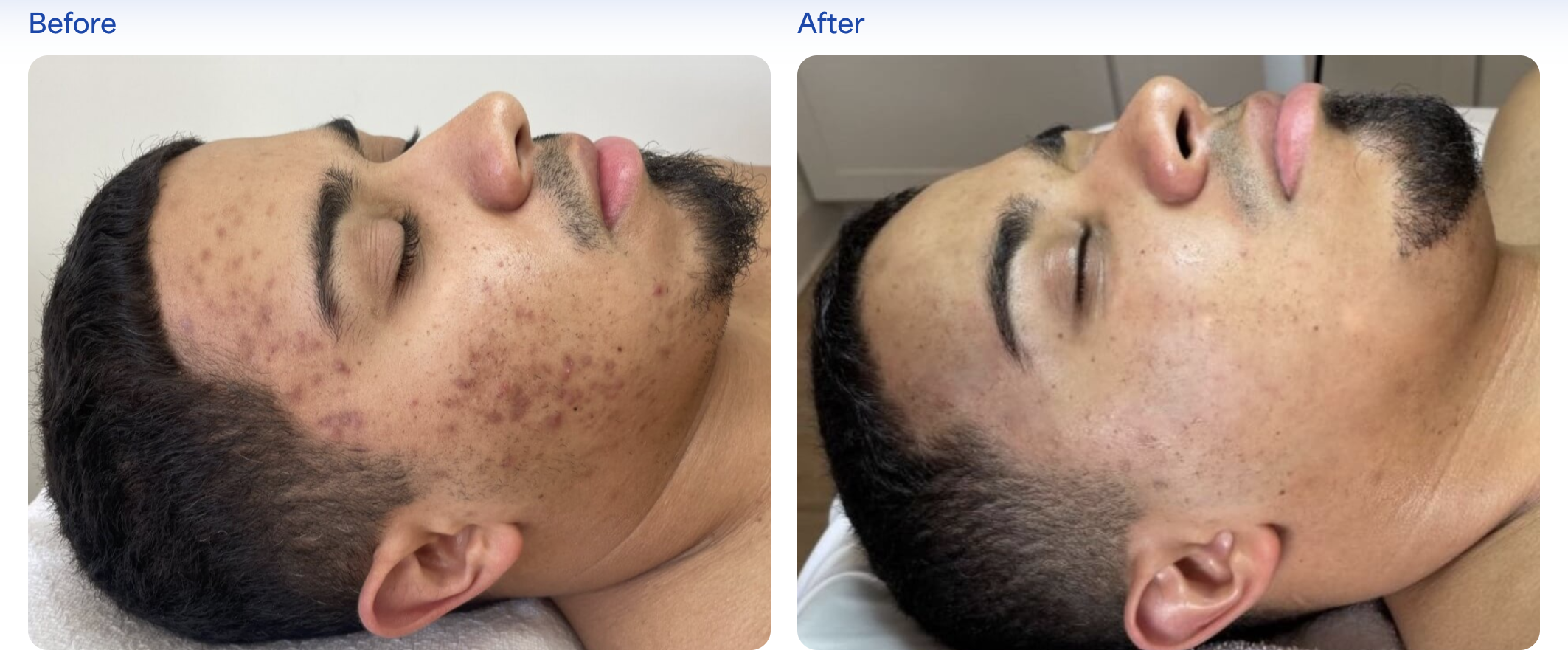 Clinical sepia tone before and after skin peel treatment at Kare Plastic Surgery Los Angeles showing diffuse hyperpigmentation and acne scarring improvement with Melapeel and Melarase protocol